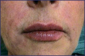 ...immediately after (incl. lip augmentation)