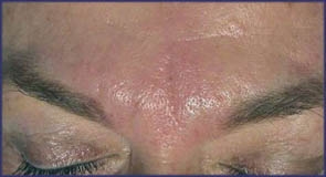 ...immediately after the treatment with Restylane