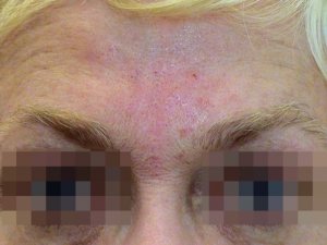 ... 1 månad senare efter Botox och direkt efter Restylane